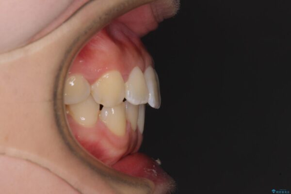 軽微な歯列不正をワイヤー矯正で整える 治療後画像