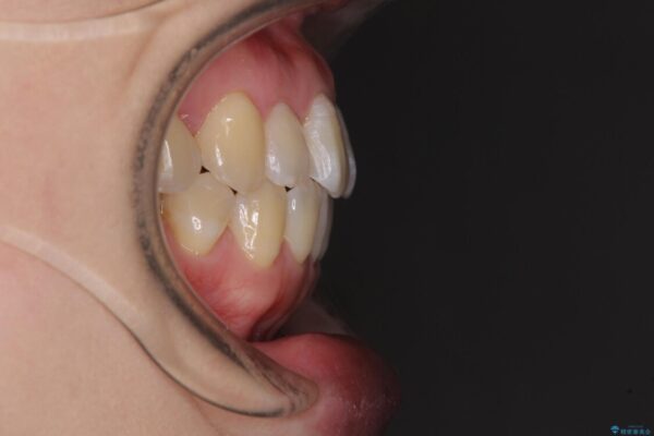 口元の突出感を改善　インビザラインによる非抜歯矯正 治療後画像