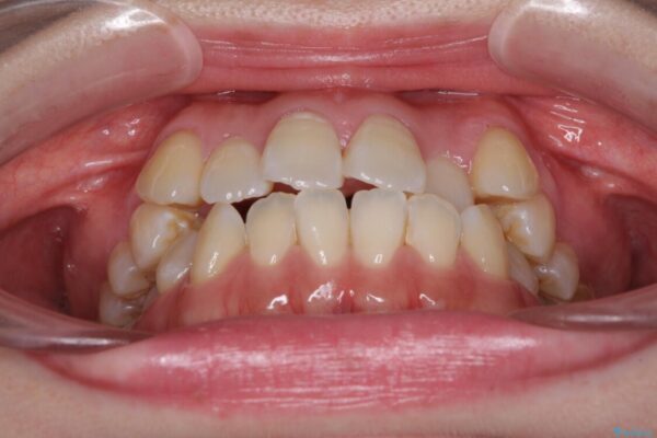 口元の突出感を改善　インビザラインによる非抜歯矯正 治療前画像
