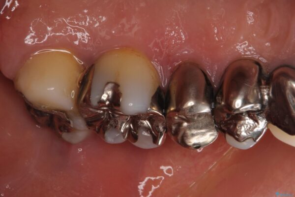 歯肉が腫れて出血する　奥歯の歯周病治療 治療前画像