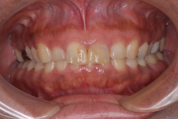 前歯の気になる変色、長さを整えてオールセラミッククラウンに 治療前画像