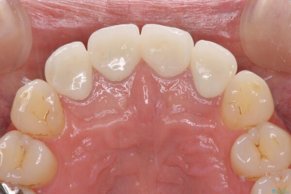 変色した歯をセラミックできれいに整える 治療後画像