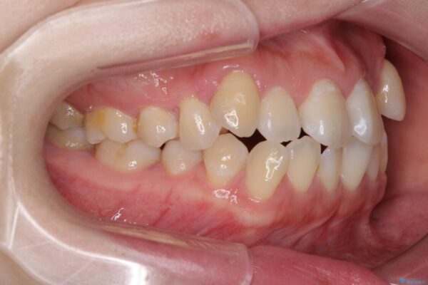 口元の突出感を改善　インビザラインによる非抜歯矯正 治療前画像