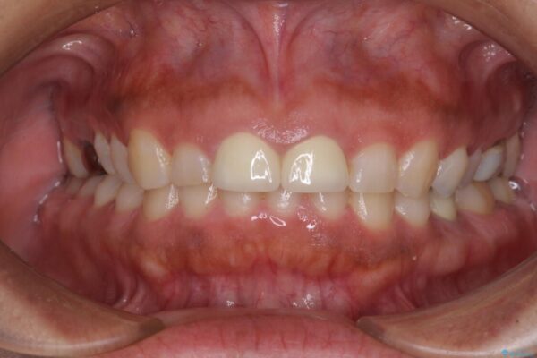 前歯の気になる変色、長さを整えてオールセラミッククラウンに 治療後画像