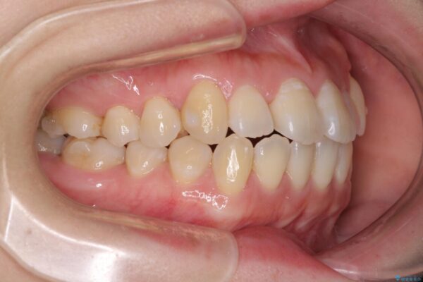 口元の突出感を改善　インビザラインによる非抜歯矯正 治療途中画像