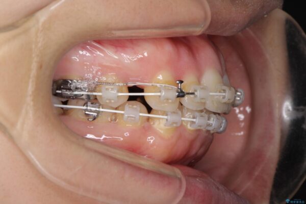 口元をスッキリと　ワイヤー装置による抜歯矯正 治療途中画像