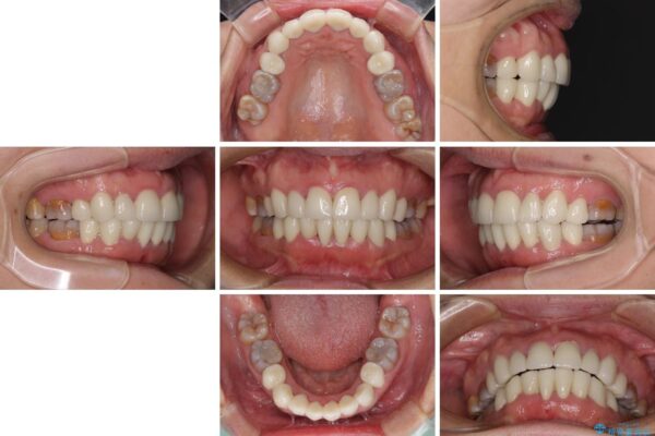矯正の後戻りと変色歯を治したい　総合歯科診療 治療後画像