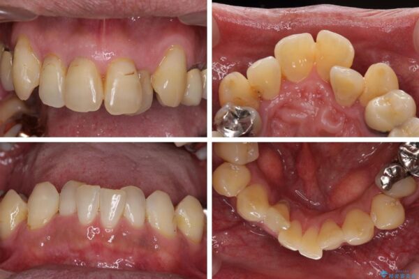 歯周病治療のための歯列矯正　総合歯科治療による全顎治療 治療前画像