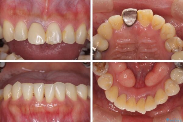 気になる部分を全て治療　総合歯科治療で口腔内環境改善 治療前画像