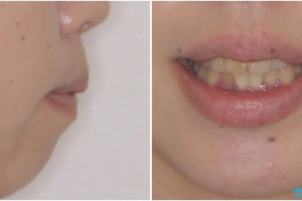 口元の突出感を改善　ワイヤー装置による抜歯矯正 治療前画像