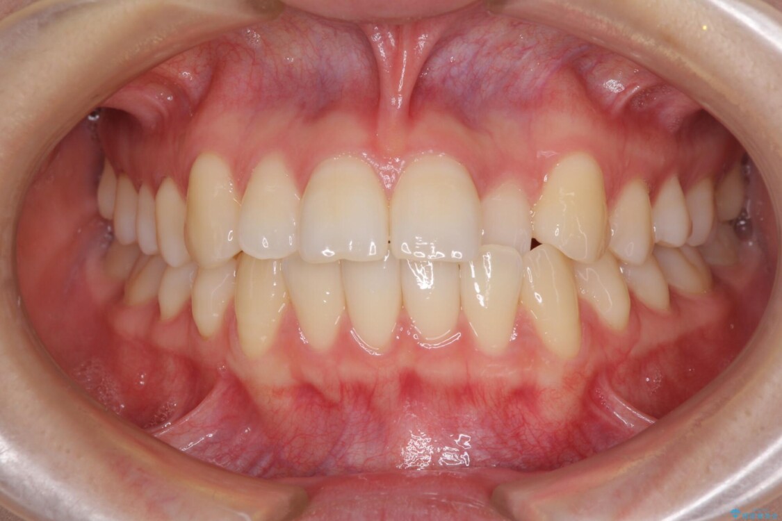前歯のクロスバイト　インビザラインによる矯正治療 治療前