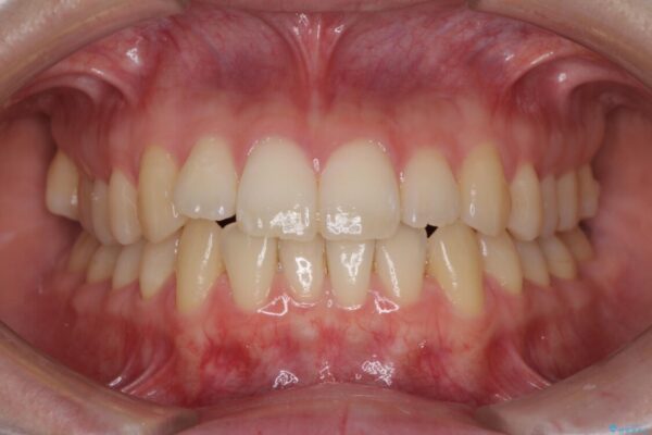 前歯の微妙なガタつきが気になる　インビザライン・ライトでの矯正治療 治療前画像