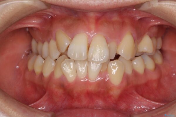 狭い上顎骨を拡大　著しい叢生を抜歯矯正で改善 治療前画像