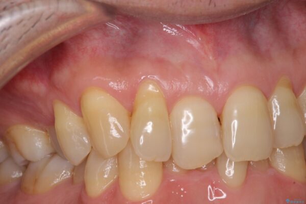 歯根が露出している歯の歯肉移植　根面被覆術 ビフォー