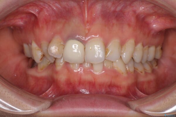 歯並びと目立つ金属を治したい　総合歯科治療 ビフォー