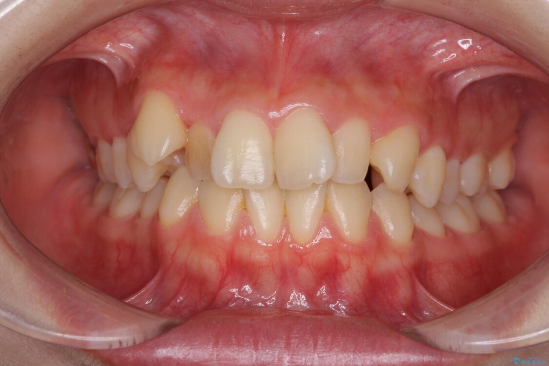 前歯2本が欠損　抜歯矯正でデコボコを治す 治療前