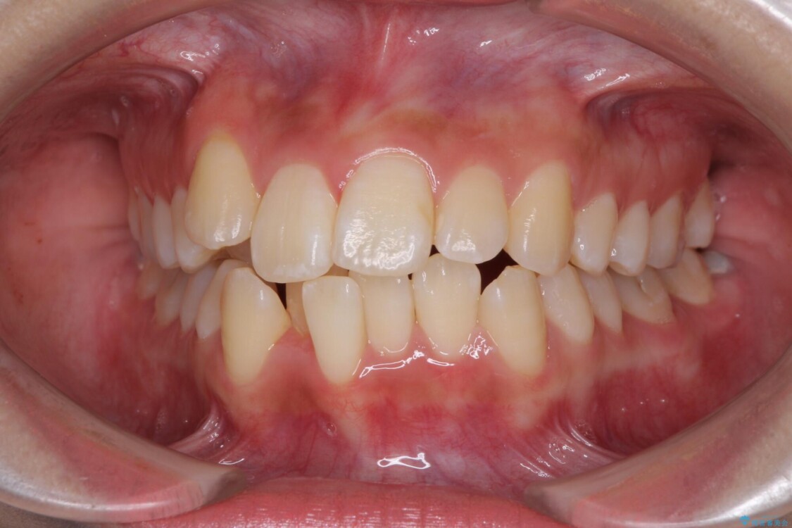 前歯の正中のズレを改善　目立たないワイヤー装置での抜歯矯正 治療前