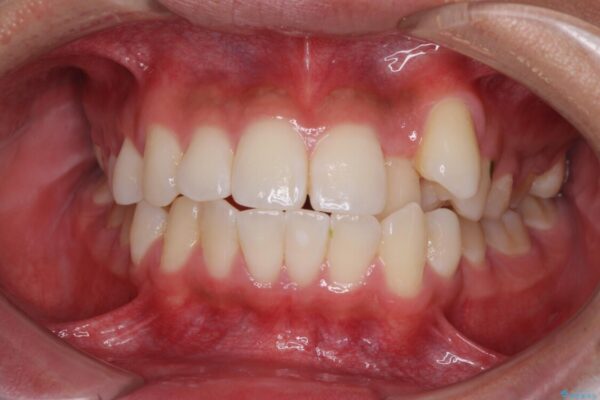 八重歯と奥歯のクロスバイト　上顎骨を拡大してインビザラインで矯正 ビフォー