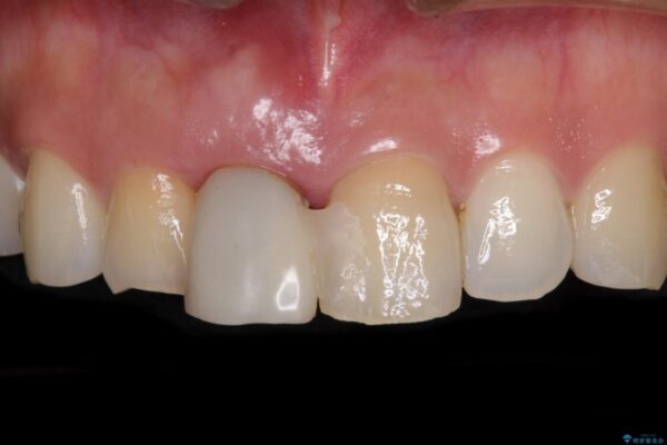 治療途中で放置した前歯　オールセラミックブリッジ 治療前画像