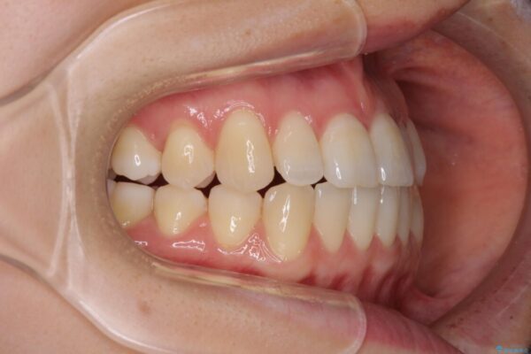 前歯のクロスバイト　インビザラインによる矯正治療 治療途中画像