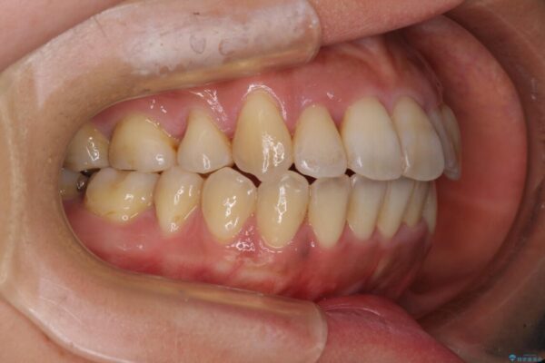 狭い上顎骨を拡大　著しい叢生を抜歯矯正で改善 治療後画像