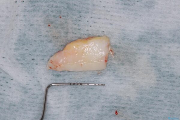 歯根が露出している歯の歯肉移植　根面被覆術 治療前画像