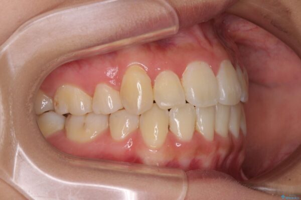 前歯の正中のズレを改善　目立たないワイヤー装置での抜歯矯正 治療後画像