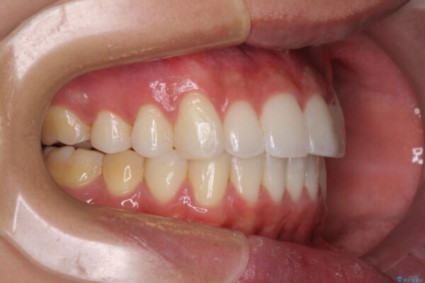 八重歯と奥歯のクロスバイト　上顎骨を拡大してインビザラインで矯正 治療後画像