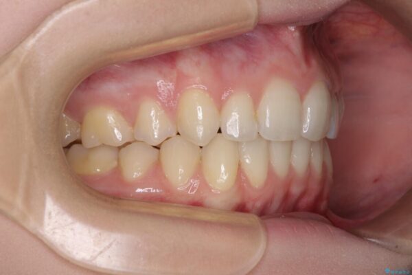 八重歯を短期間で改善　ワイヤー装置による抜歯矯正 治療後画像