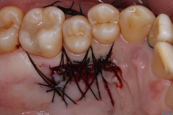 歯根が露出している歯の歯肉移植　根面被覆術 治療途中画像