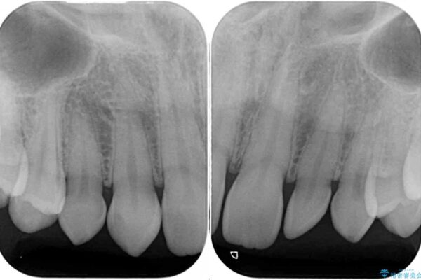前歯の奇形歯　オールセラミッククラウンによる審美歯科治療 治療前画像