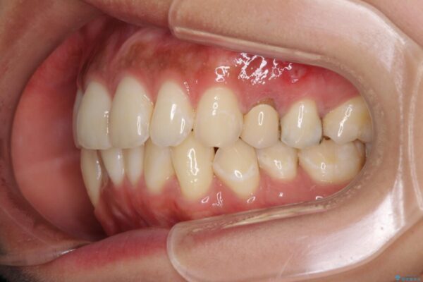 八重歯の再矯正　インビザラインでストレスなく矯正治療 治療前画像