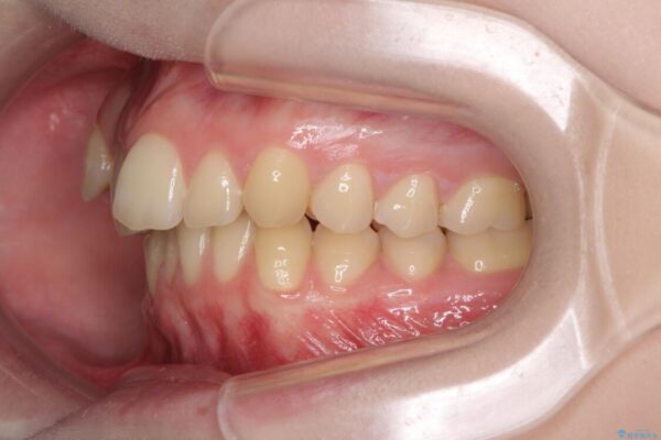 八重歯を短期間で改善　ワイヤー装置による抜歯矯正 治療前画像