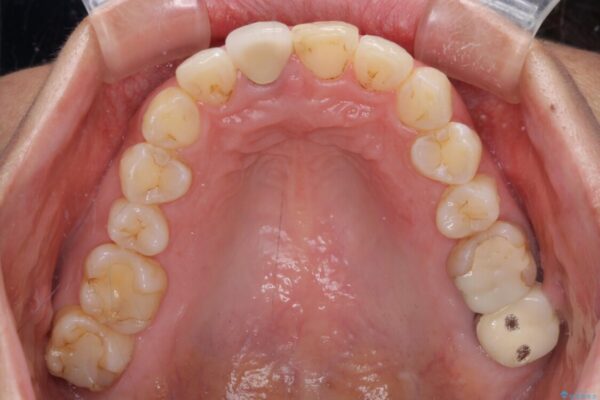目立つ前歯の詰め物　オーダーメイドのセラミッククラウンで審美的に仕上げる 治療前画像