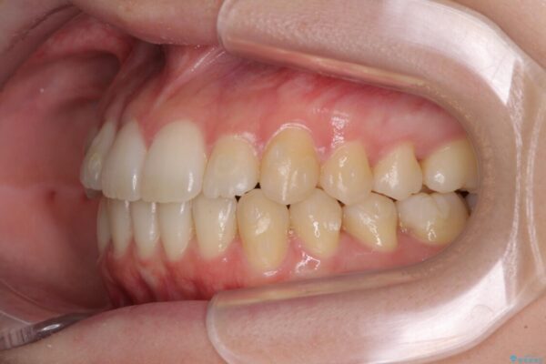 前歯の微妙なガタつきが気になる　インビザライン・ライトでの矯正治療 治療途中画像