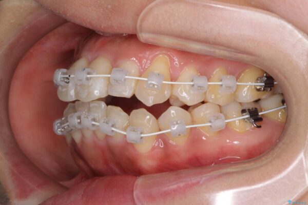 狭い上顎骨を拡大　著しい叢生を抜歯矯正で改善 治療途中画像
