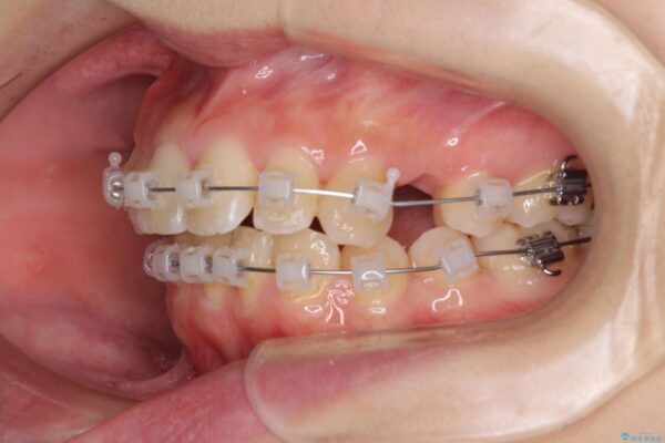 前歯2本が欠損　抜歯矯正でデコボコを治す 治療途中画像