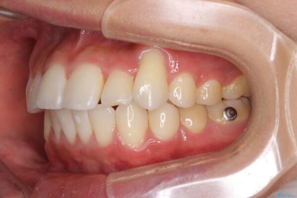 八重歯と奥歯のクロスバイト　上顎骨を拡大してインビザラインで矯正 治療途中画像