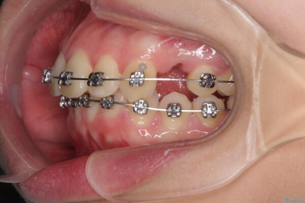 費用を抑えた抜歯矯正　口元の突出感の改善 治療途中画像
