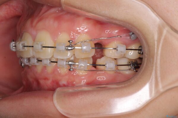 部分矯正で出っ歯になってしまった　出っ歯改善の抜歯矯正 治療途中画像