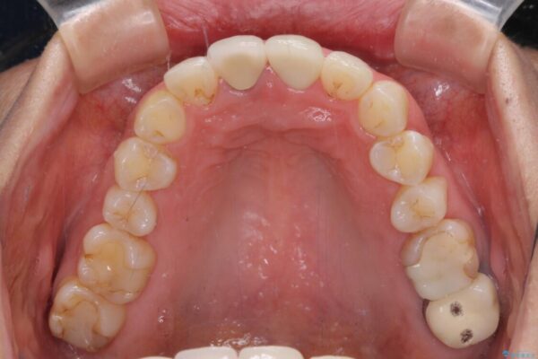 目立つ前歯の詰め物　オーダーメイドのセラミッククラウンで審美的に仕上げる 治療後画像