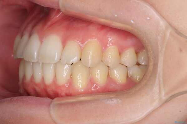 前歯の微妙なガタつきが気になる　インビザライン・ライトでの矯正治療 治療後画像
