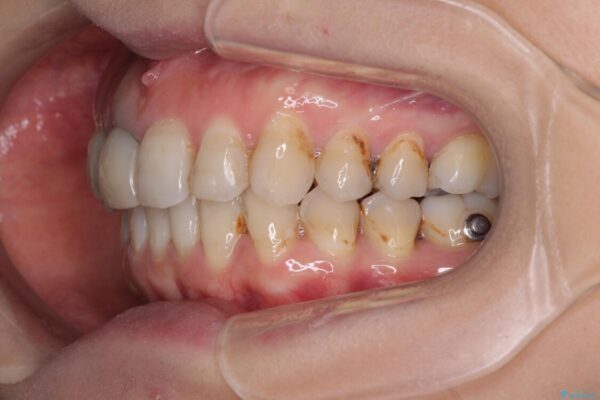 歯並びと目立つ金属を治したい　総合歯科治療 治療途中画像