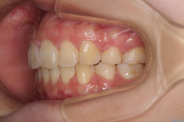 部分矯正で出っ歯になってしまった　出っ歯改善の抜歯矯正 治療後画像