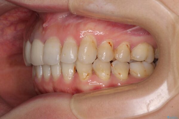 歯並びと目立つ金属を治したい　総合歯科治療 治療後画像