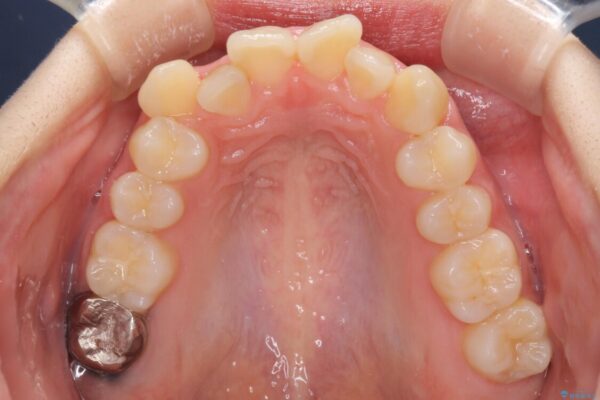 前歯2本が欠損　抜歯矯正でデコボコを治す 治療前画像