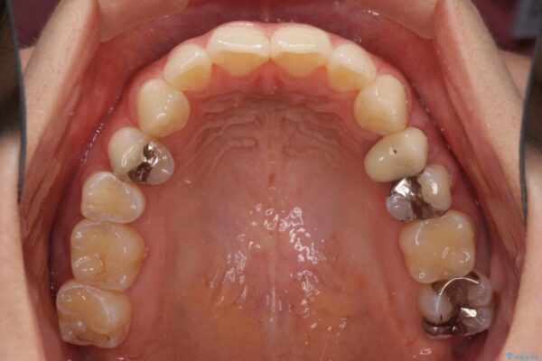 八重歯の再矯正　インビザラインでストレスなく矯正治療 治療前画像