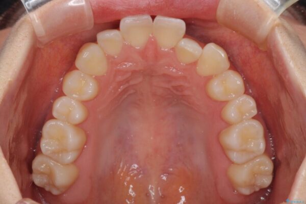 前歯のクロスバイト　インビザラインによる矯正治療 治療前画像