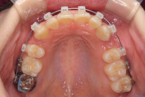 前歯2本が欠損　抜歯矯正でデコボコを治す 治療途中画像