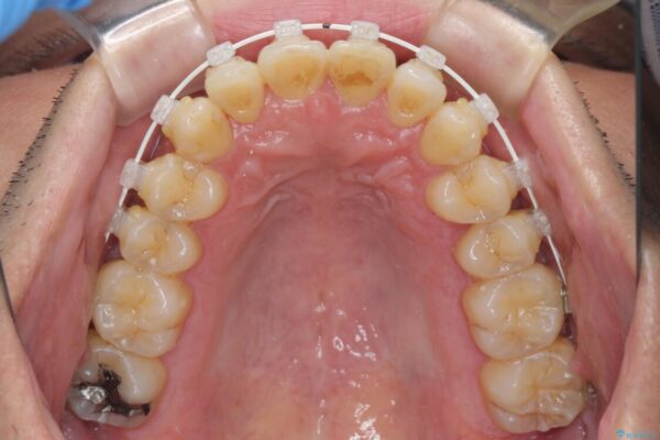 前歯のデコボコ　ワイヤー装置での短期間治療 治療途中画像